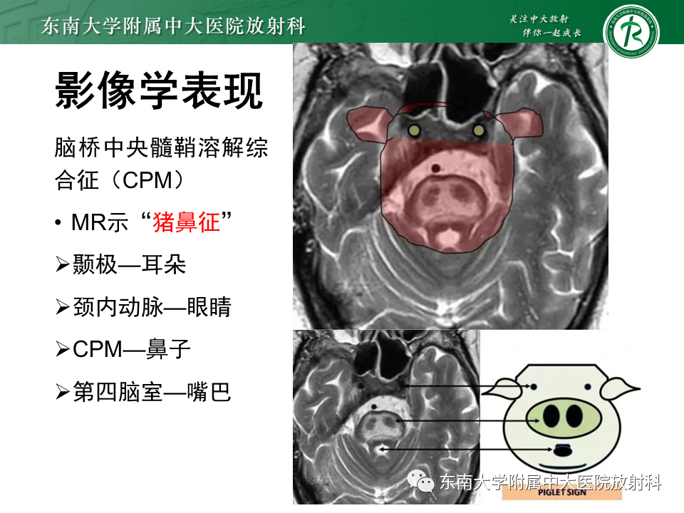 影像PPT - 【PPT】渗透性脱髓鞘综合征-14 影像PPT - 【PPT】渗透性脱髓鞘综合征-14