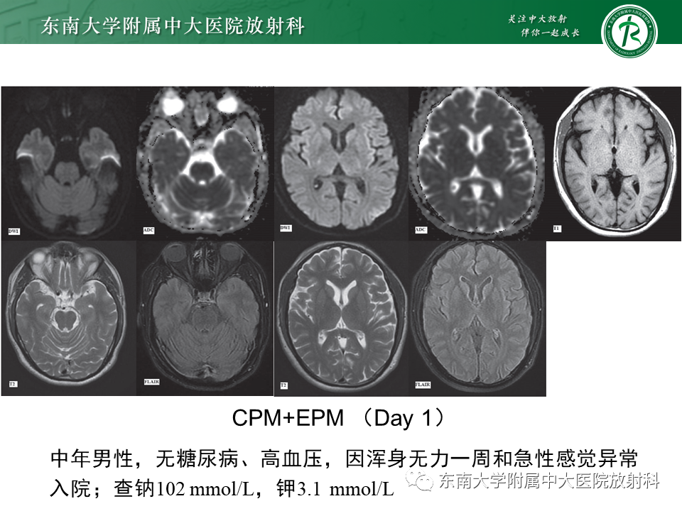 影像PPT - 【PPT】渗透性脱髓鞘综合征-16 影像PPT - 【PPT】渗透性脱髓鞘综合征-16