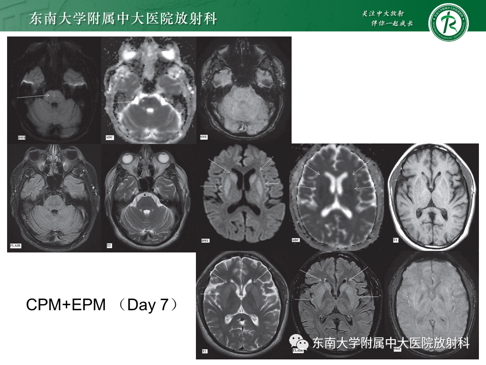 影像PPT - 【PPT】渗透性脱髓鞘综合征-17 影像PPT - 【PPT】渗透性脱髓鞘综合征-17
