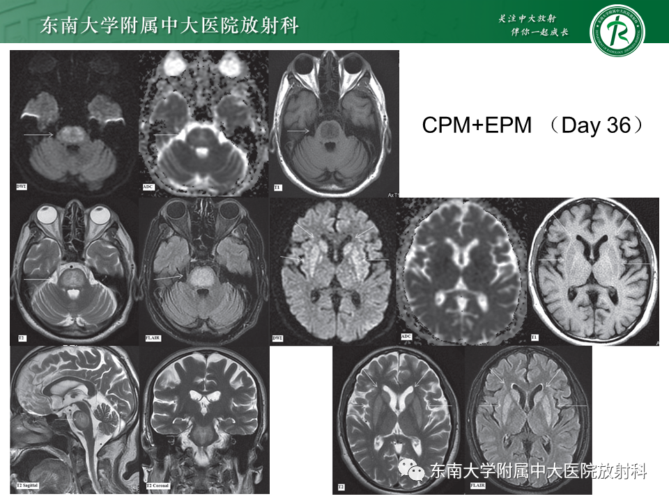 影像PPT - 【PPT】渗透性脱髓鞘综合征-19 影像PPT - 【PPT】渗透性脱髓鞘综合征-19