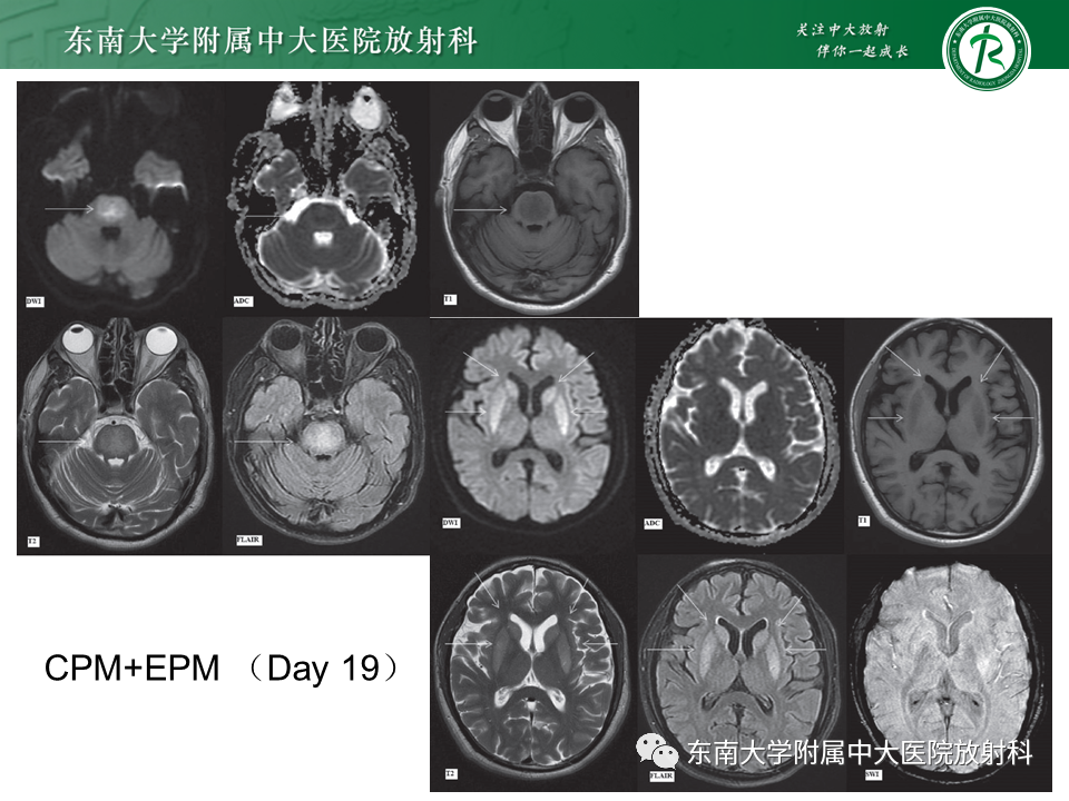 影像PPT - 【PPT】渗透性脱髓鞘综合征-18 影像PPT - 【PPT】渗透性脱髓鞘综合征-18