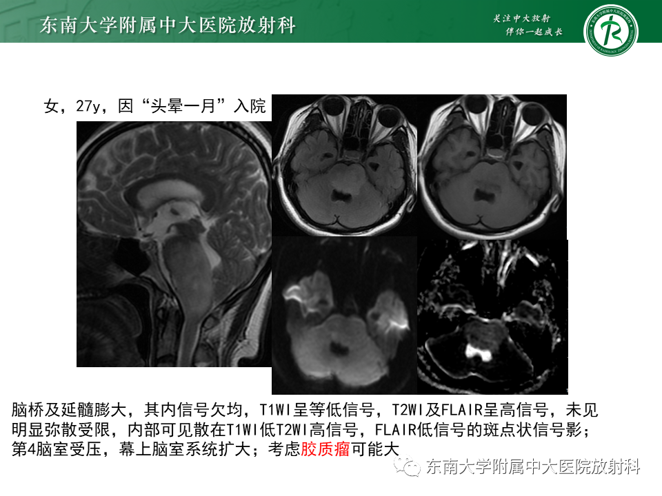影像PPT - 【PPT】渗透性脱髓鞘综合征-26 影像PPT - 【PPT】渗透性脱髓鞘综合征-26