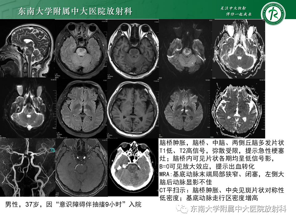 影像PPT - 【PPT】渗透性脱髓鞘综合征-24 影像PPT - 【PPT】渗透性脱髓鞘综合征-24