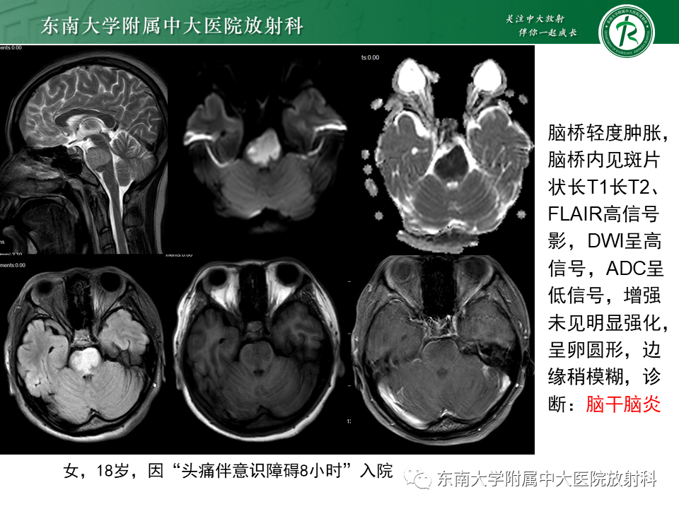 影像PPT - 【PPT】渗透性脱髓鞘综合征-28 影像PPT - 【PPT】渗透性脱髓鞘综合征-28