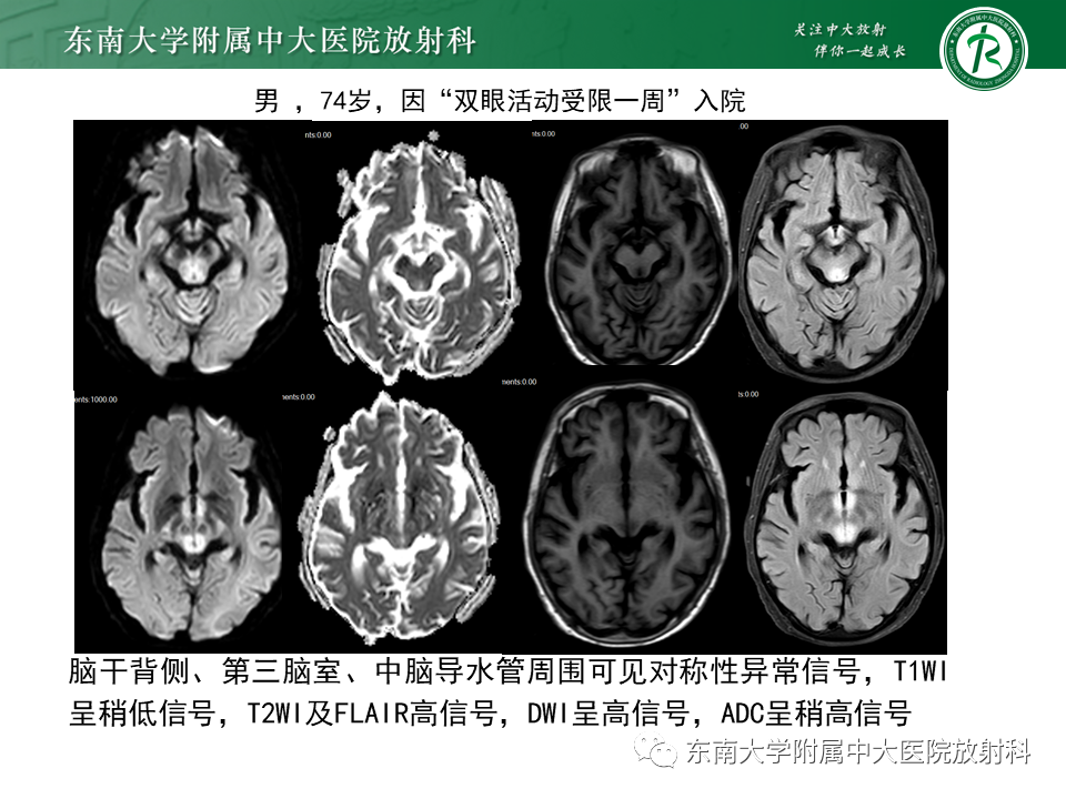 影像PPT - 【PPT】渗透性脱髓鞘综合征-30 影像PPT - 【PPT】渗透性脱髓鞘综合征-30