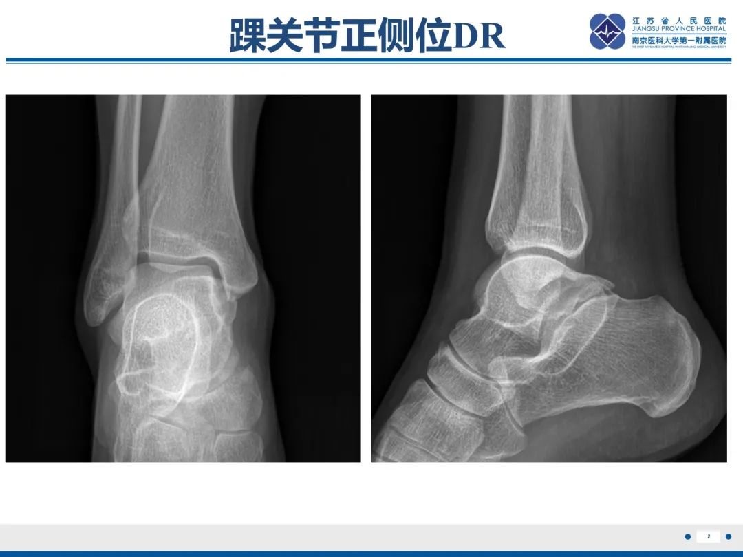 影像PPT - 【PPT】跟骨距骨桥-3