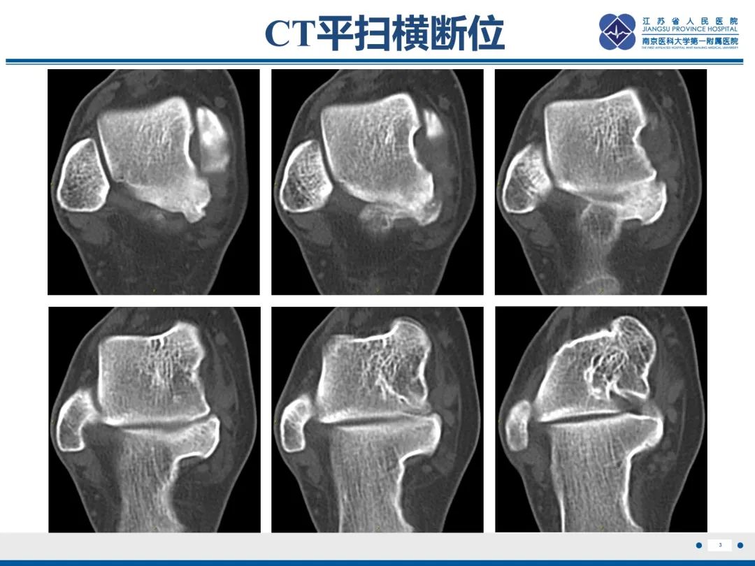 影像PPT - 【PPT】跟骨距骨桥-4