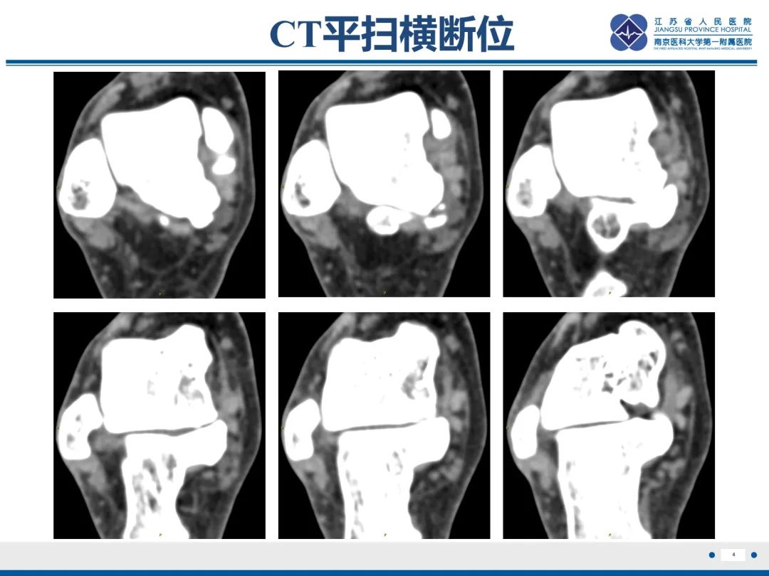 影像PPT - 【PPT】跟骨距骨桥-5