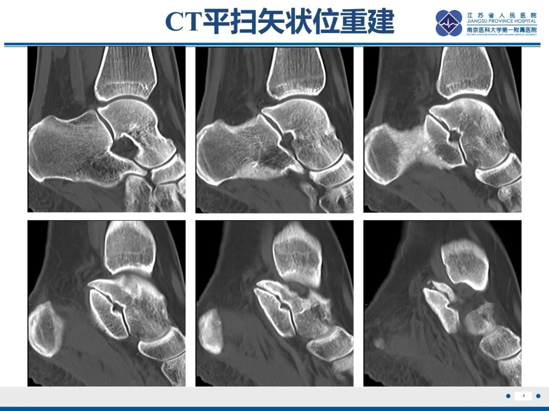 影像PPT - 【PPT】跟骨距骨桥-6