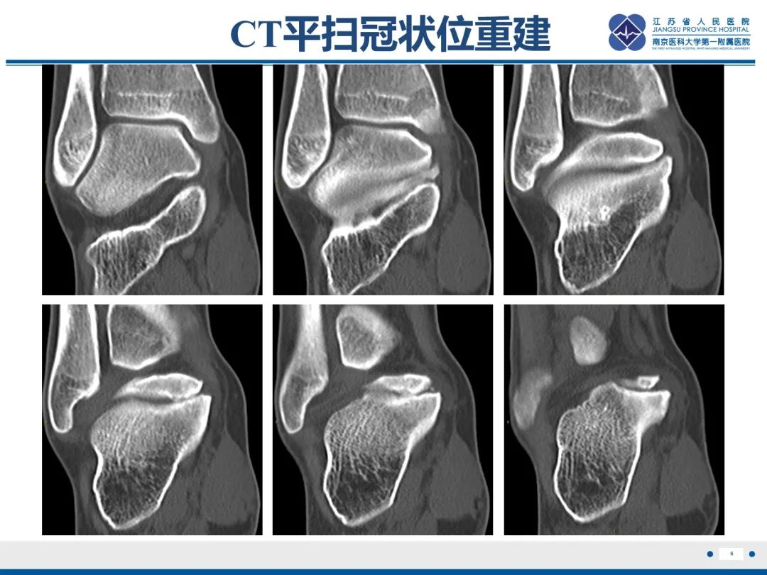 影像PPT - 【PPT】跟骨距骨桥-7