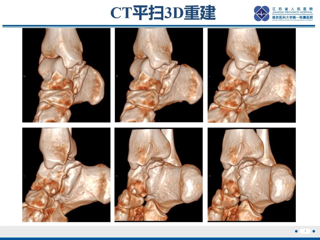 影像PPT - 【PPT】跟骨距骨桥-8