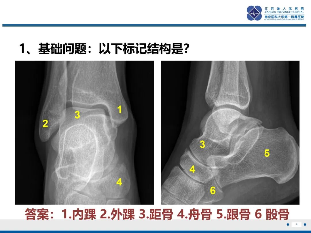 影像PPT - 【PPT】跟骨距骨桥-10
