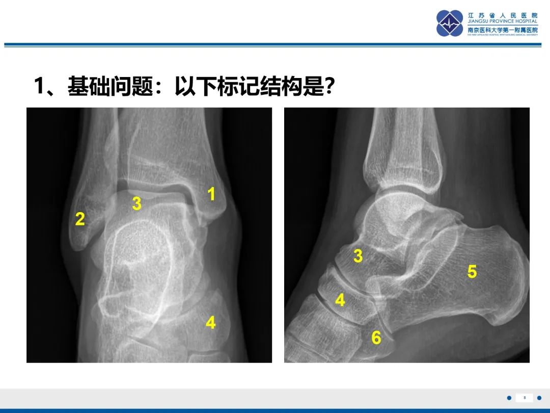 影像PPT - 【PPT】跟骨距骨桥-9