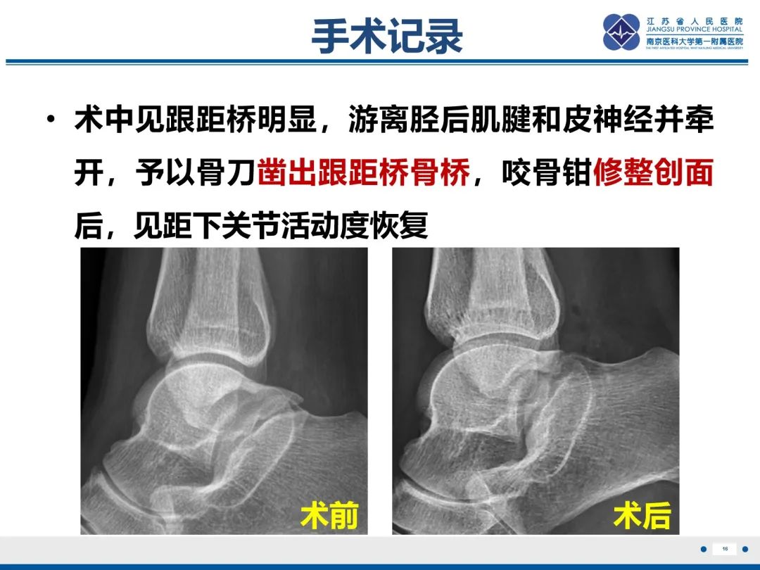 影像PPT - 【PPT】跟骨距骨桥-17