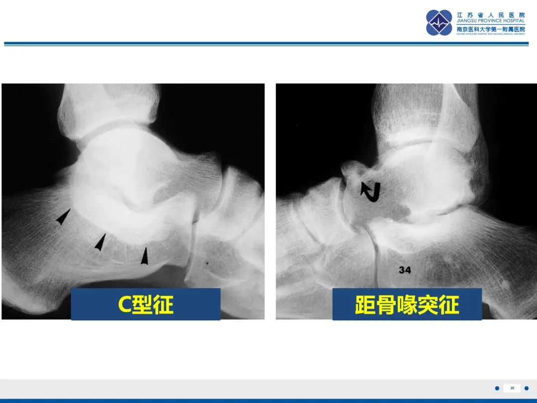 影像PPT - 【PPT】跟骨距骨桥-27