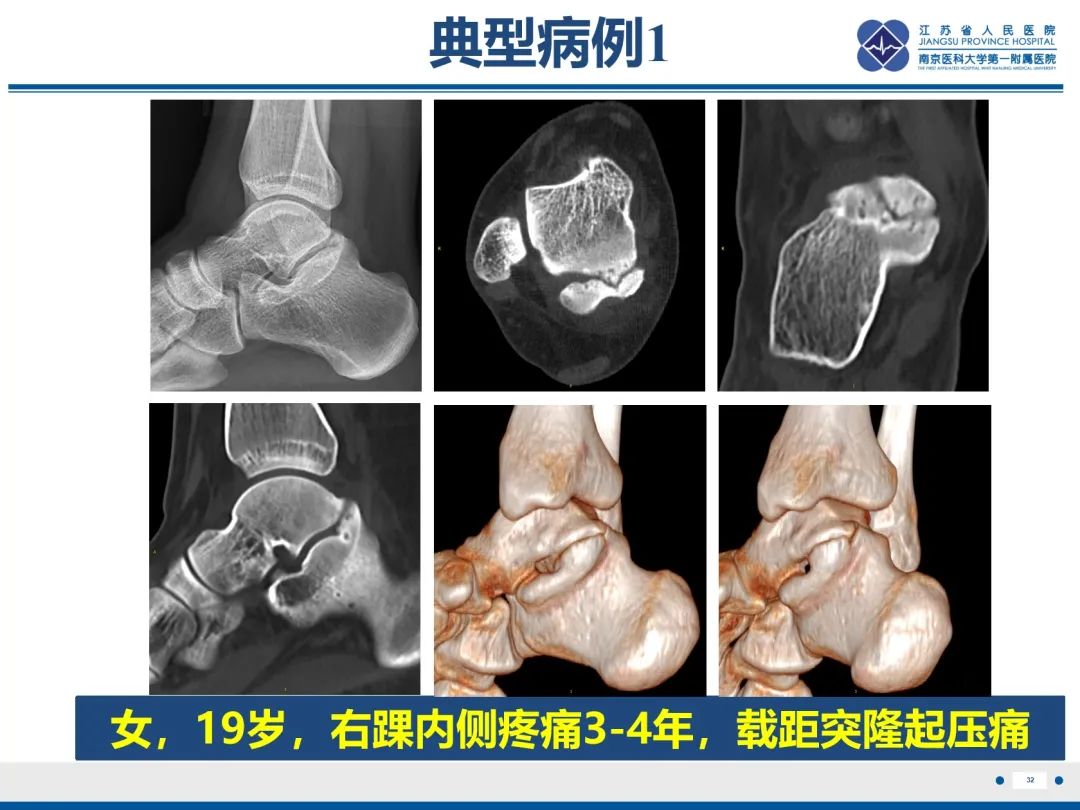 影像PPT - 【PPT】跟骨距骨桥-33