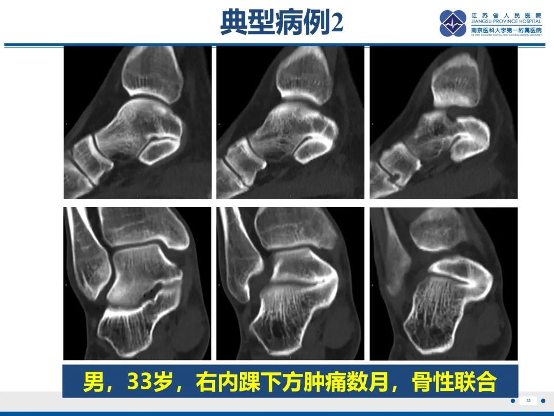 影像PPT - 【PPT】跟骨距骨桥-34