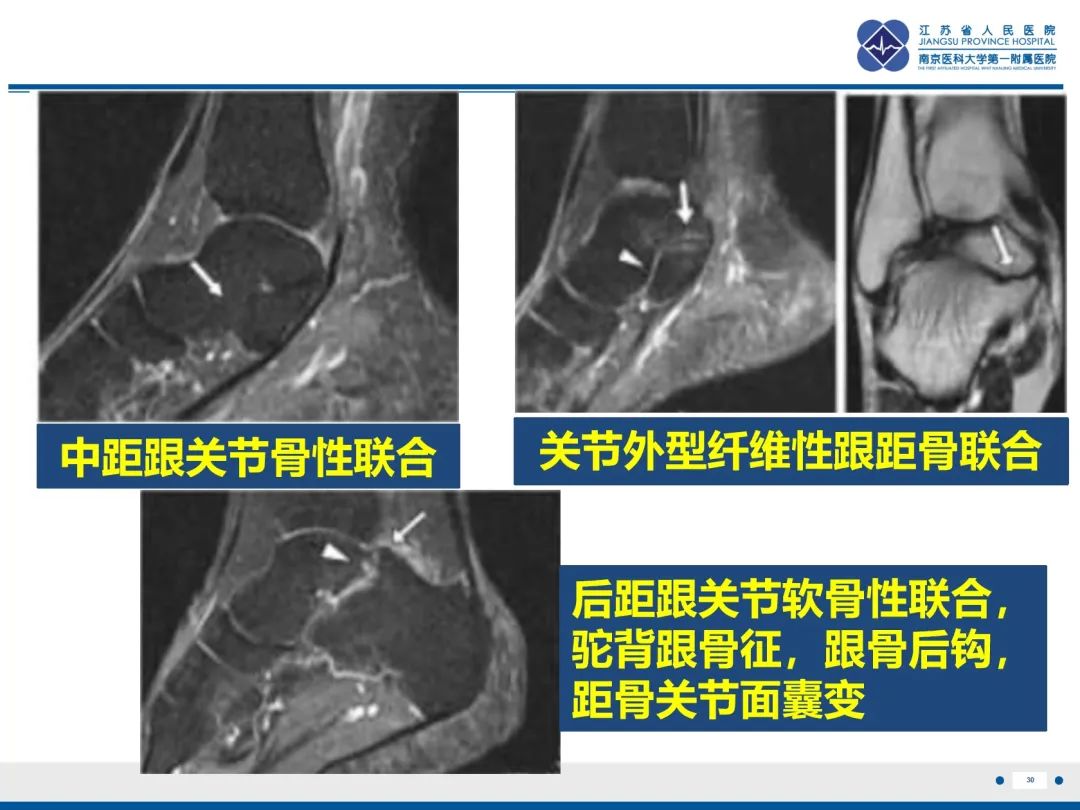影像PPT - 【PPT】跟骨距骨桥-31