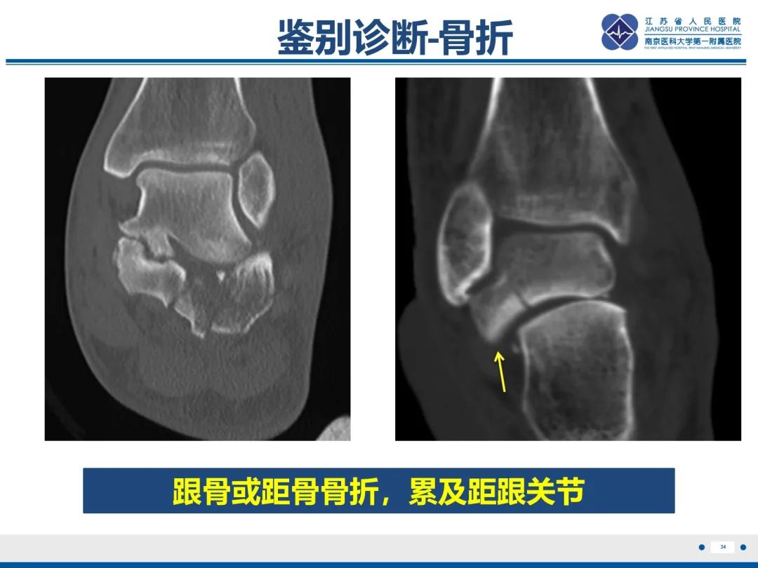影像PPT - 【PPT】跟骨距骨桥-35