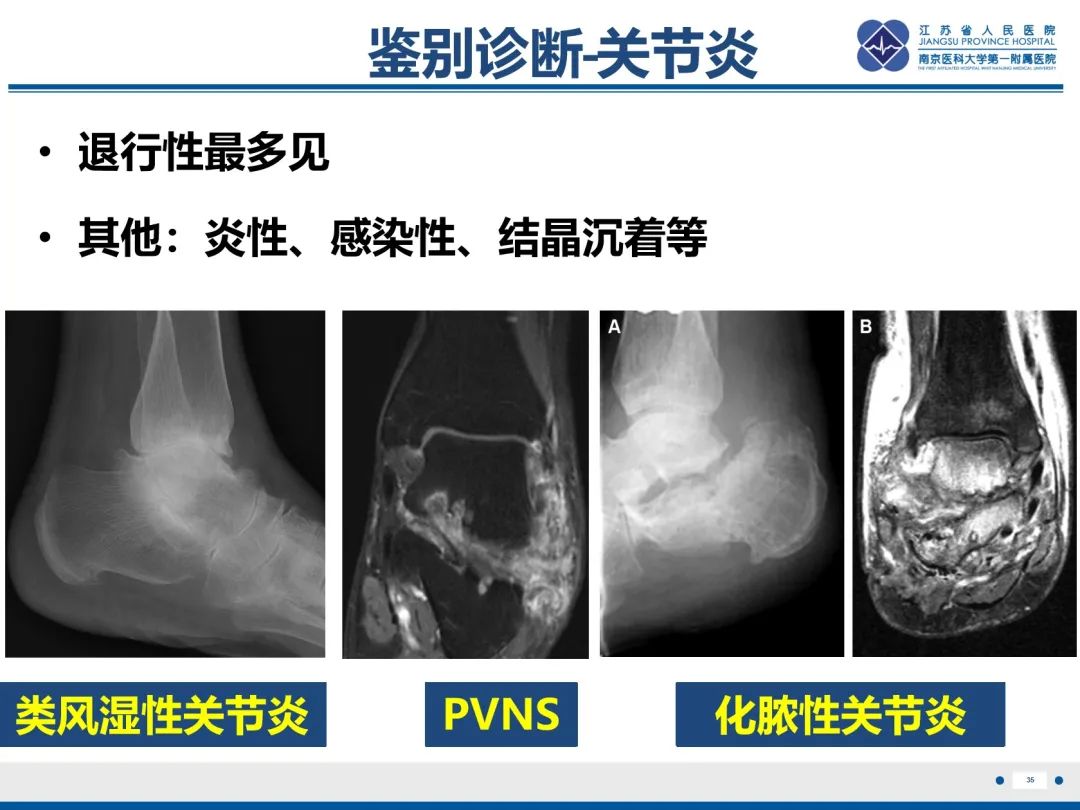 影像PPT - 【PPT】跟骨距骨桥-36