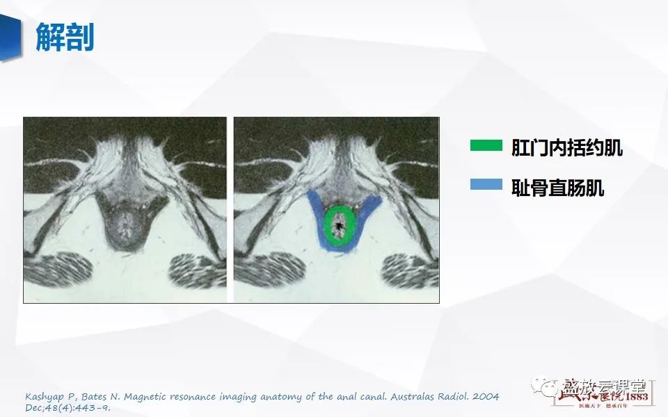 影像PPT - 【PPT】肛瘘的MRI诊断-10