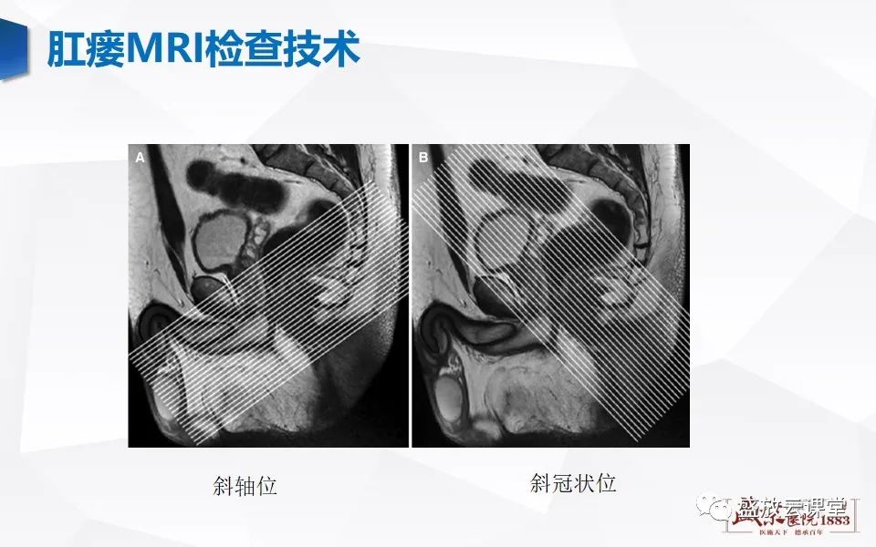 影像PPT - 【PPT】肛瘘的MRI诊断-17