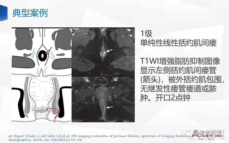 影像PPT - 【PPT】肛瘘的MRI诊断-23