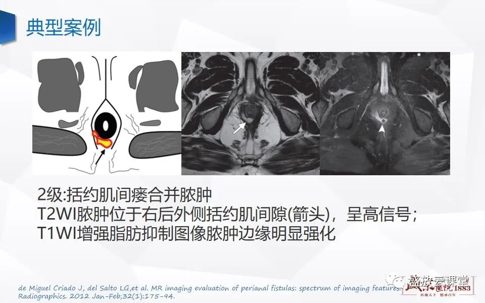 影像PPT - 【PPT】肛瘘的MRI诊断-24