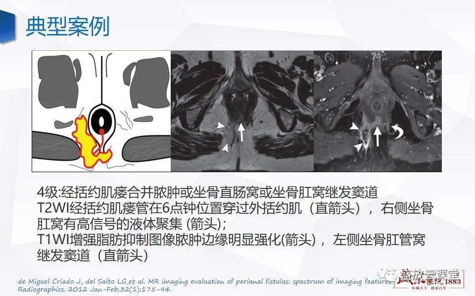影像PPT - 【PPT】肛瘘的MRI诊断-27