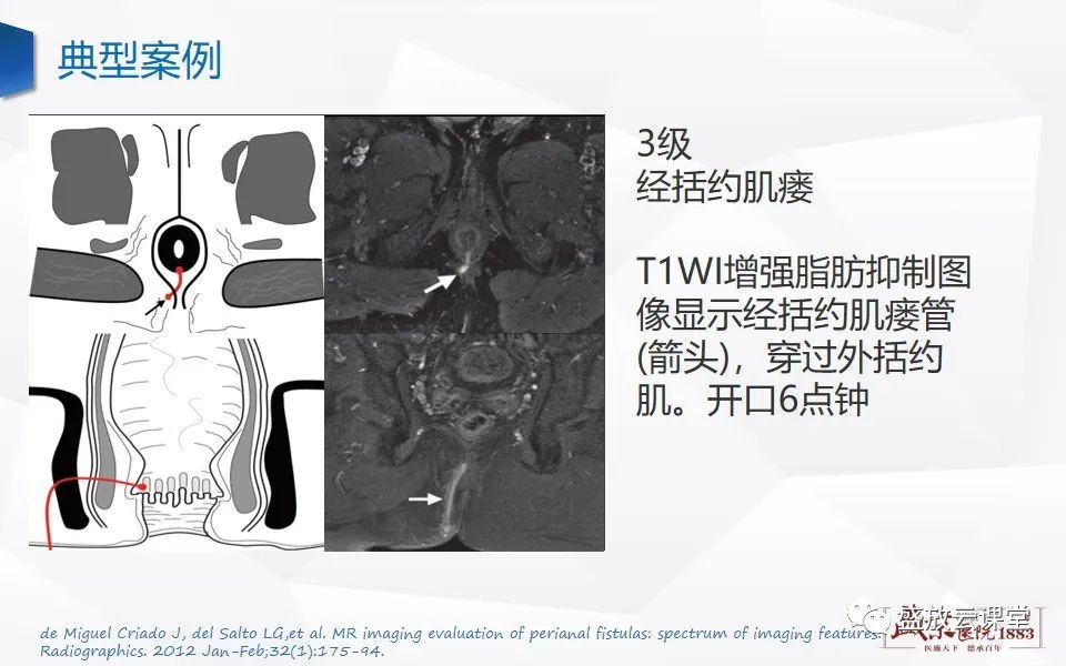 影像PPT - 【PPT】肛瘘的MRI诊断-26