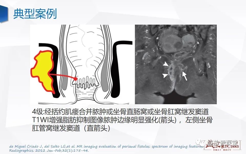 影像PPT - 【PPT】肛瘘的MRI诊断-28