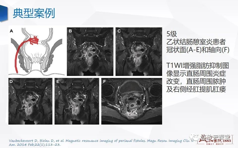 影像PPT - 【PPT】肛瘘的MRI诊断-29