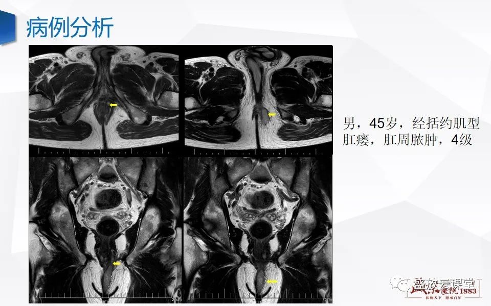 影像PPT - 【PPT】肛瘘的MRI诊断-31