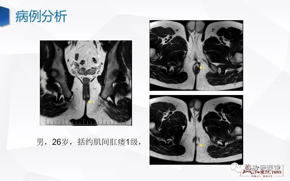 影像PPT - 【PPT】肛瘘的MRI诊断-30