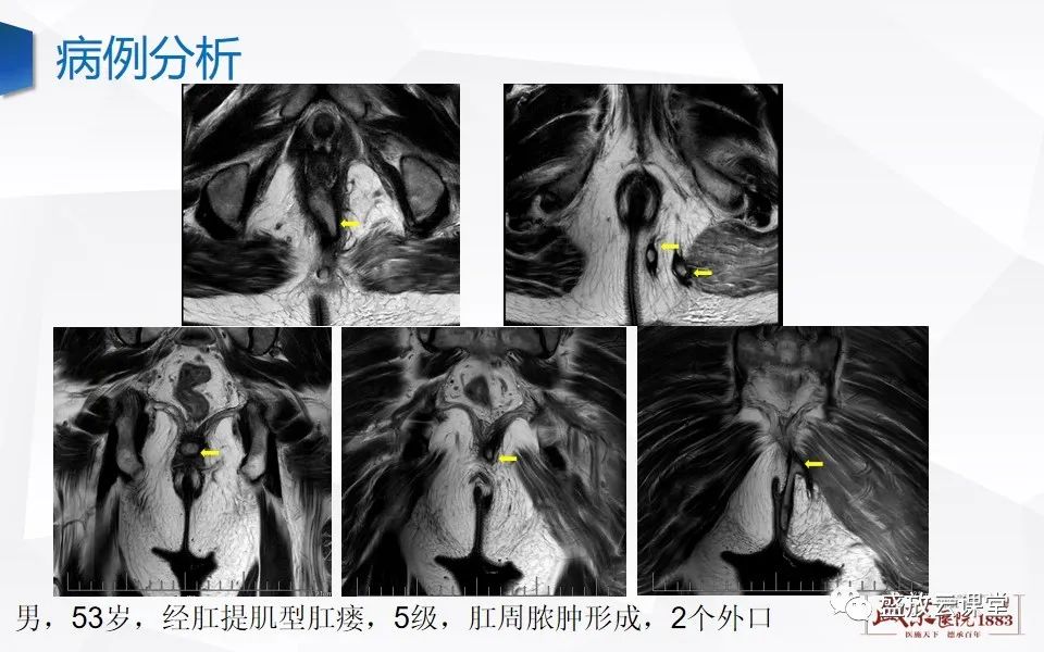 影像PPT - 【PPT】肛瘘的MRI诊断-33