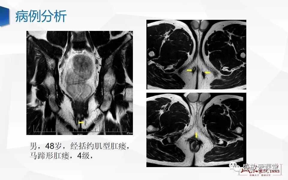 影像PPT - 【PPT】肛瘘的MRI诊断-32