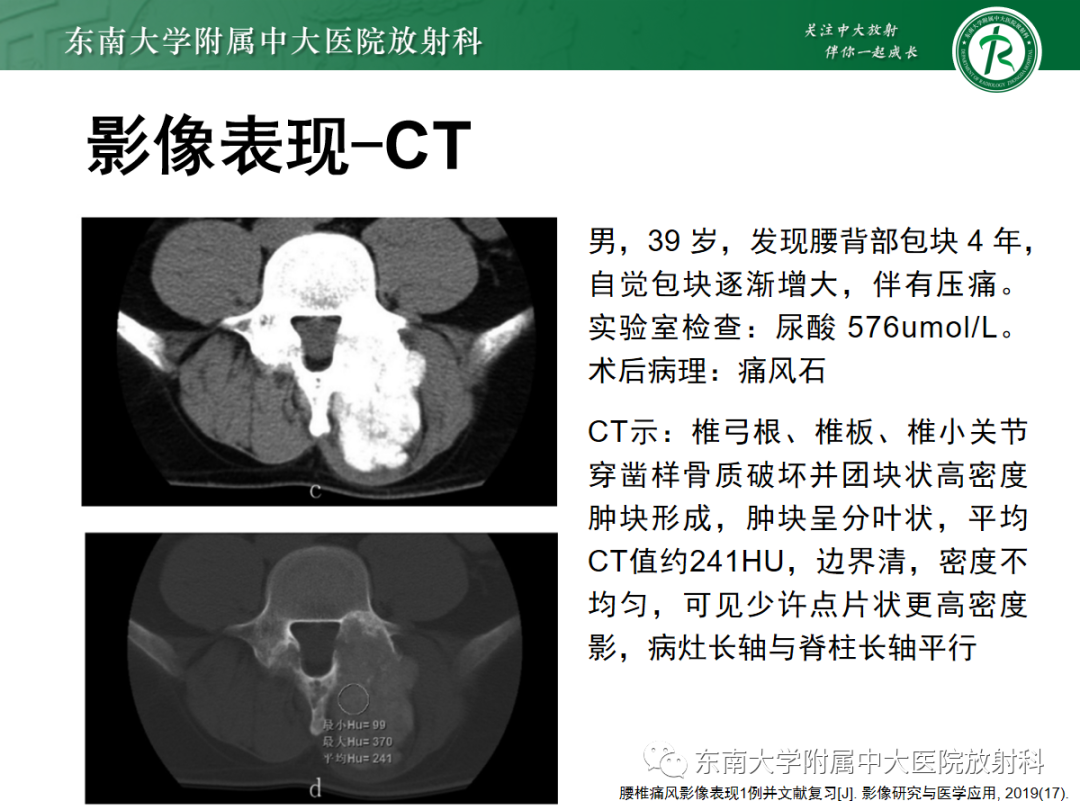 影像PPT - 【PPT】痛风性关节炎——脊柱痛风-11 影像PPT - 【PPT】痛风性关节炎——脊柱痛风-11