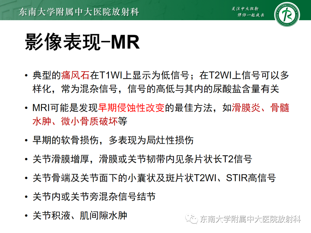 影像PPT - 【PPT】痛风性关节炎——脊柱痛风-12 影像PPT - 【PPT】痛风性关节炎——脊柱痛风-12