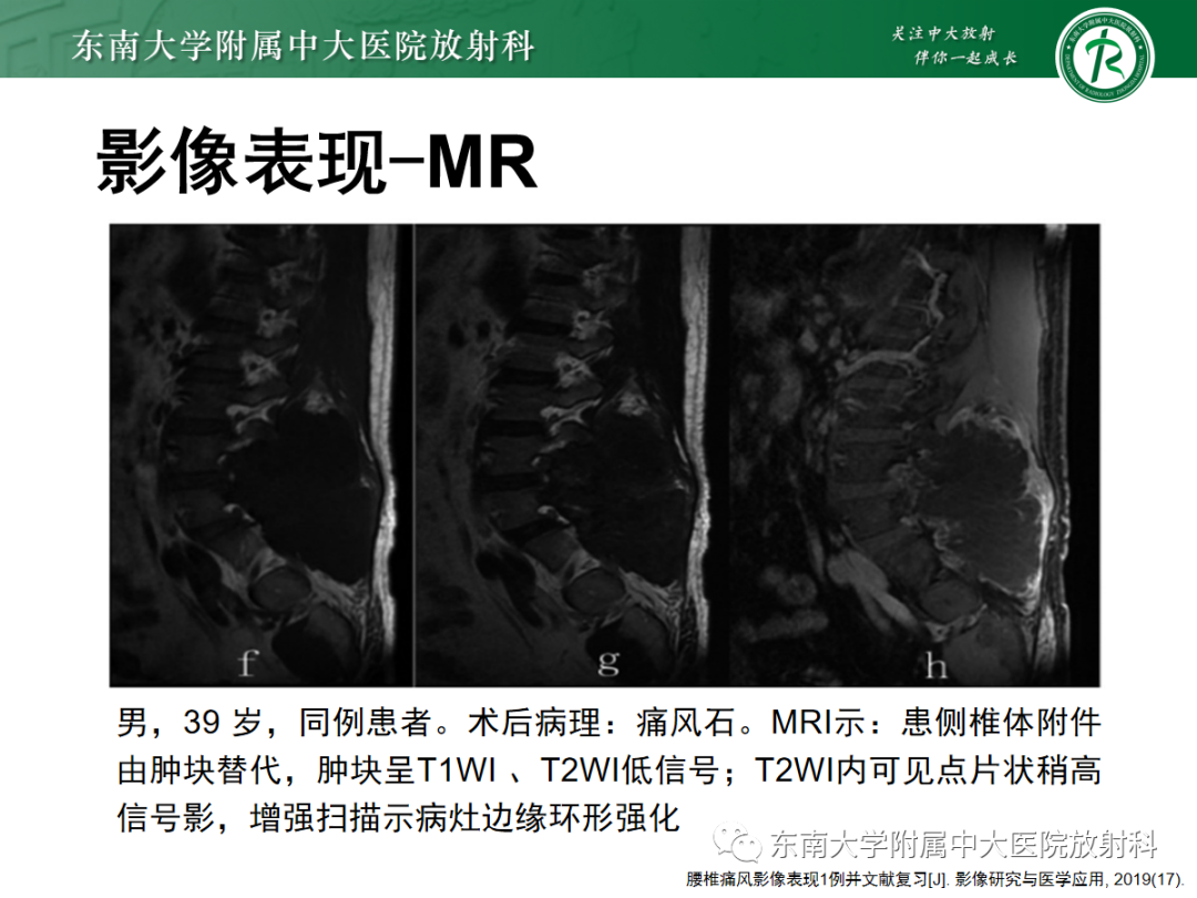影像PPT - 【PPT】痛风性关节炎——脊柱痛风-13 影像PPT - 【PPT】痛风性关节炎——脊柱痛风-13