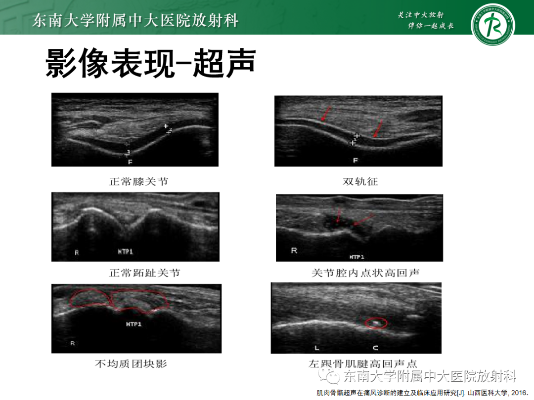 影像PPT - 【PPT】痛风性关节炎——脊柱痛风-15 影像PPT - 【PPT】痛风性关节炎——脊柱痛风-15