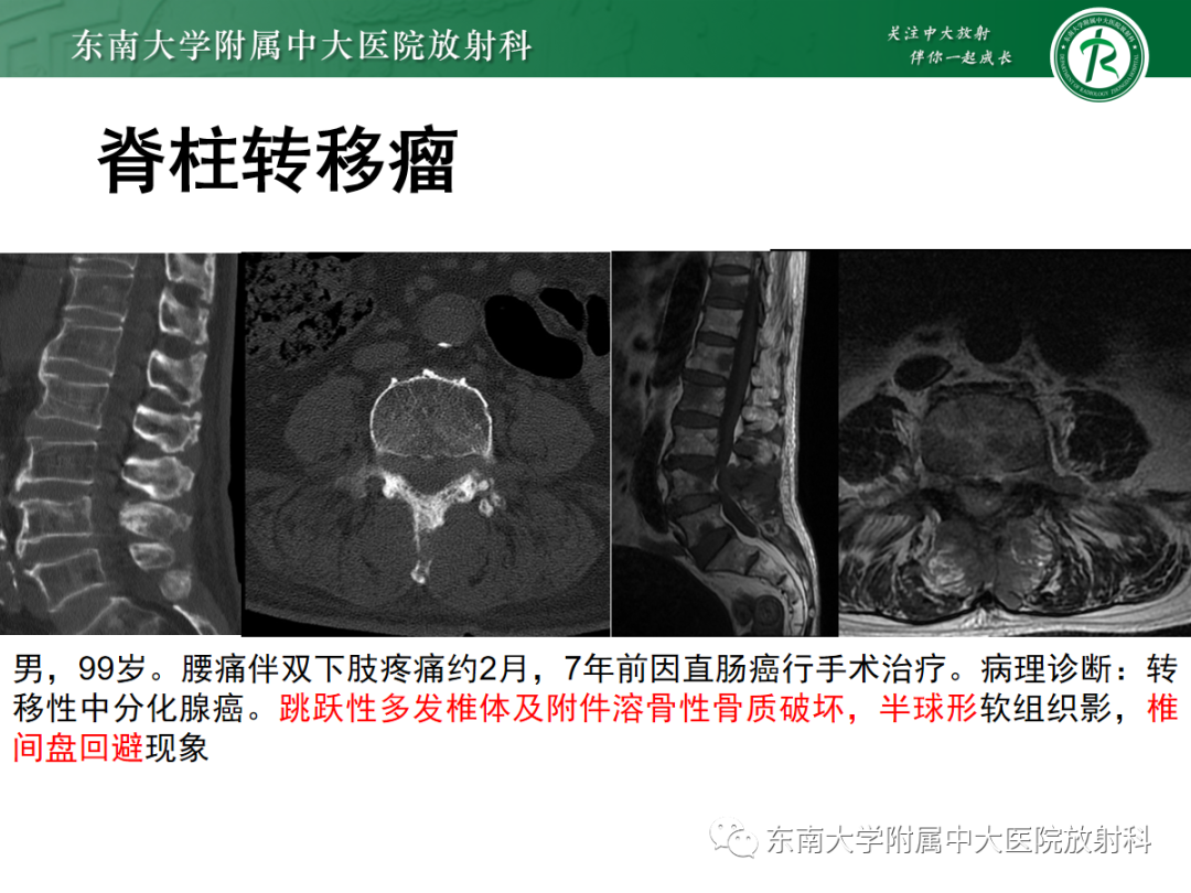 影像PPT - 【PPT】痛风性关节炎——脊柱痛风-18 影像PPT - 【PPT】痛风性关节炎——脊柱痛风-18