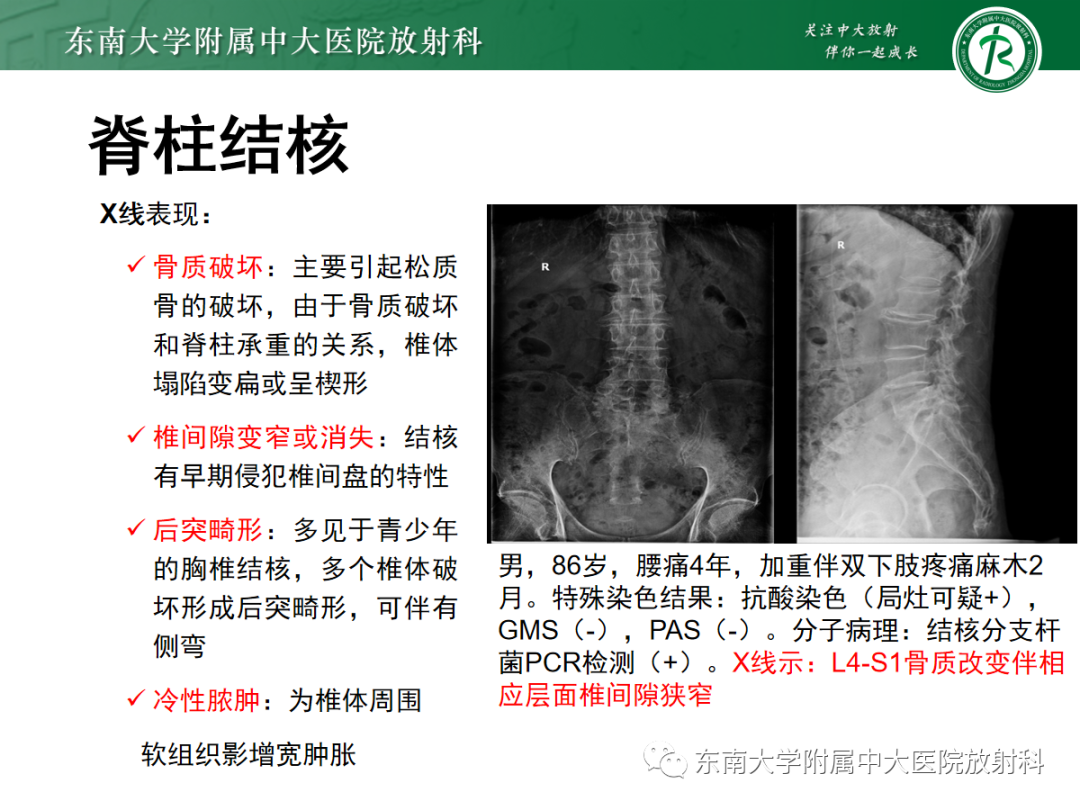 影像PPT - 【PPT】痛风性关节炎——脊柱痛风-20 影像PPT - 【PPT】痛风性关节炎——脊柱痛风-20