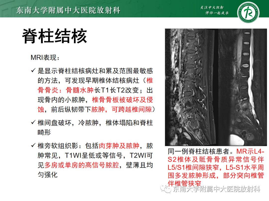 影像PPT - 【PPT】痛风性关节炎——脊柱痛风-22 影像PPT - 【PPT】痛风性关节炎——脊柱痛风-22