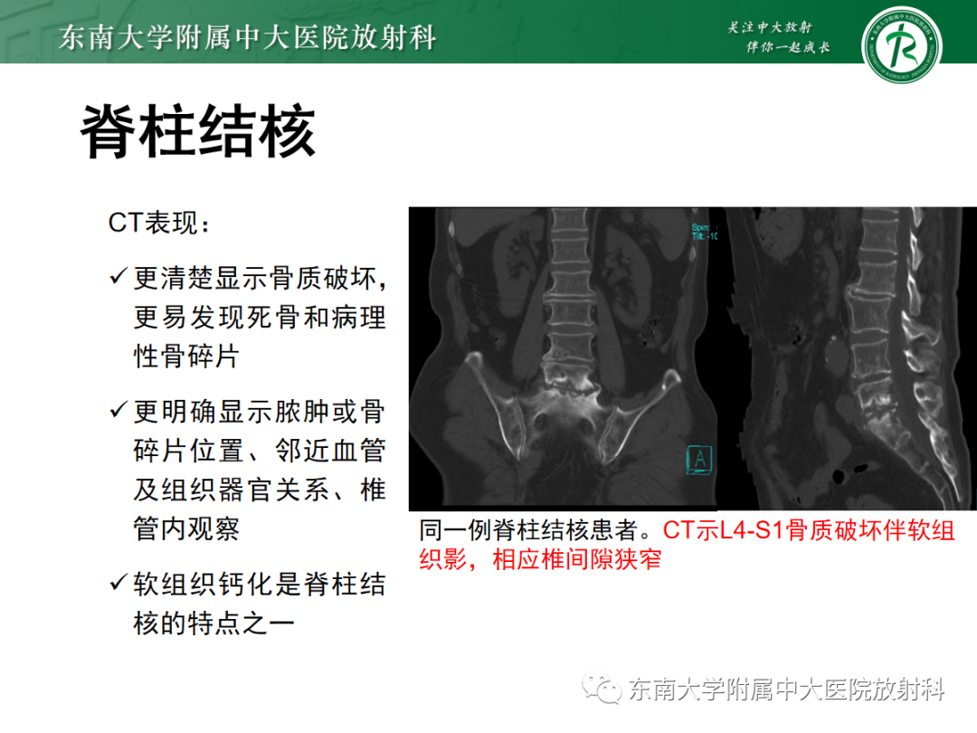 影像PPT - 【PPT】痛风性关节炎——脊柱痛风-21 影像PPT - 【PPT】痛风性关节炎——脊柱痛风-21