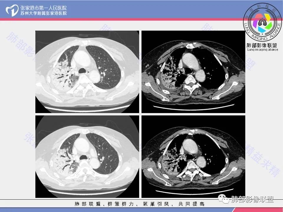 影像PPT - 【病例】隐源性机化性肺炎1例CT影像-8 影像PPT - 【病例】隐源性机化性肺炎1例CT影像-8