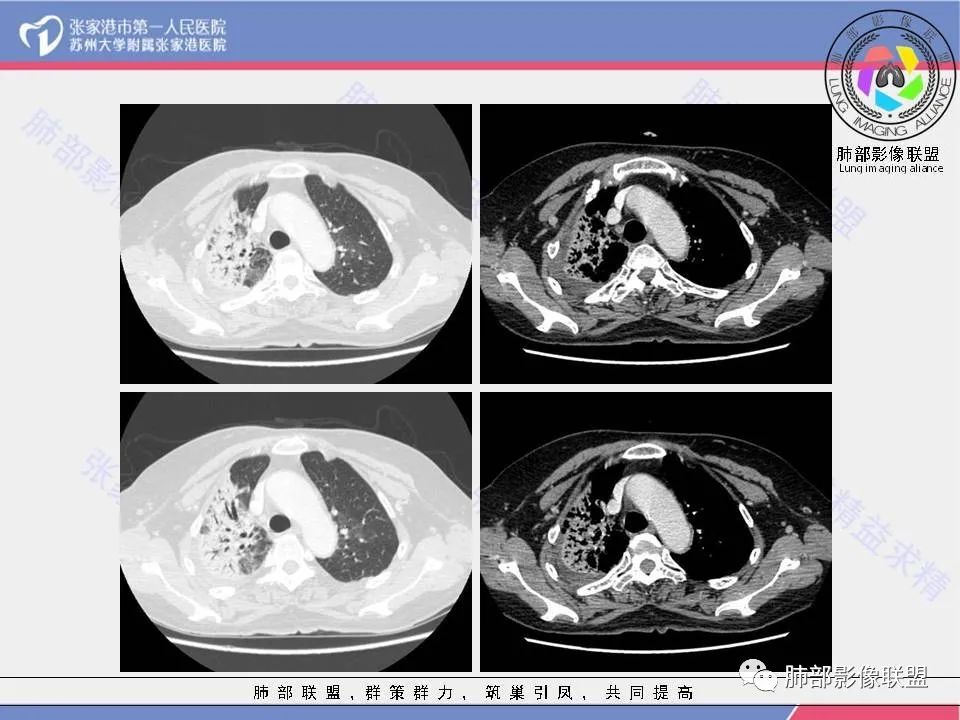 影像PPT - 【病例】隐源性机化性肺炎1例CT影像-6 影像PPT - 【病例】隐源性机化性肺炎1例CT影像-6