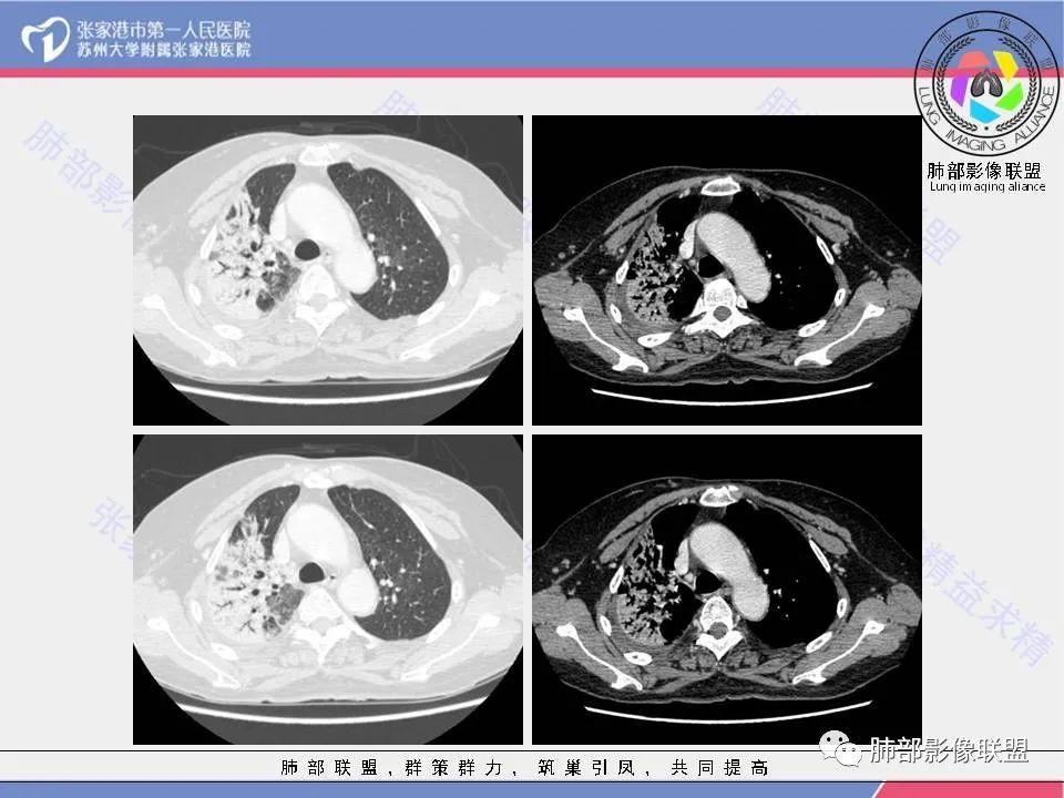 影像PPT - 【病例】隐源性机化性肺炎1例CT影像-7 影像PPT - 【病例】隐源性机化性肺炎1例CT影像-7