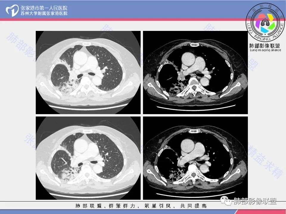 影像PPT - 【病例】隐源性机化性肺炎1例CT影像-11 影像PPT - 【病例】隐源性机化性肺炎1例CT影像-11