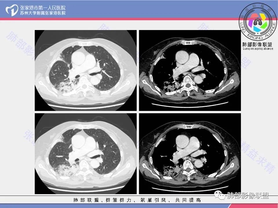 影像PPT - 【病例】隐源性机化性肺炎1例CT影像-12 影像PPT - 【病例】隐源性机化性肺炎1例CT影像-12