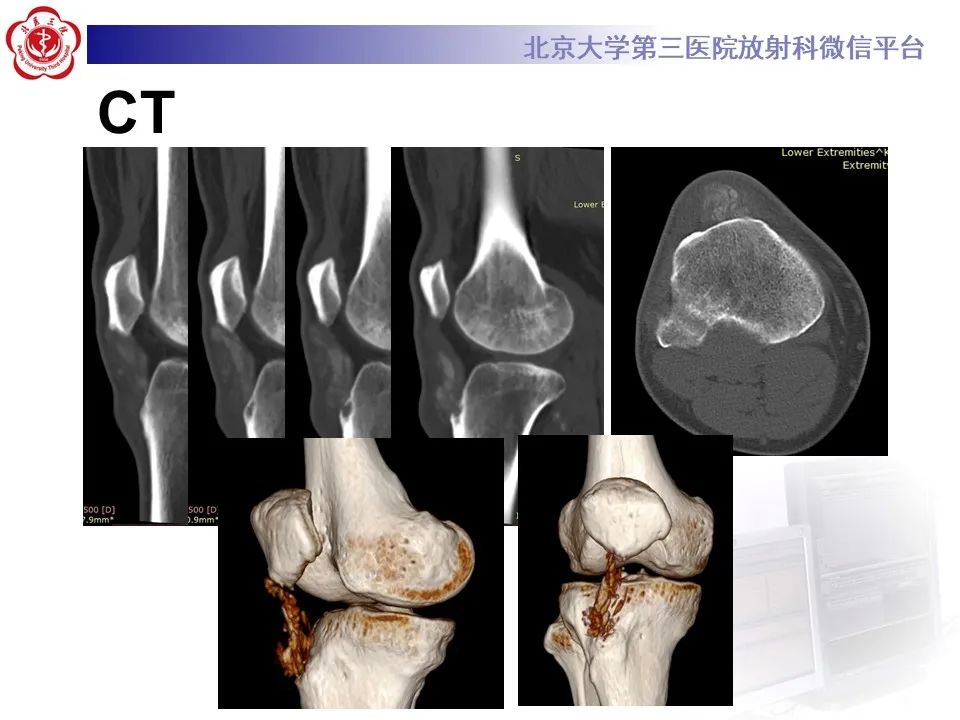影像PPT - 【PPT】痛风性膝关节炎-5